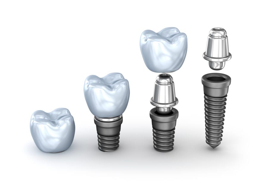 dental implant structure