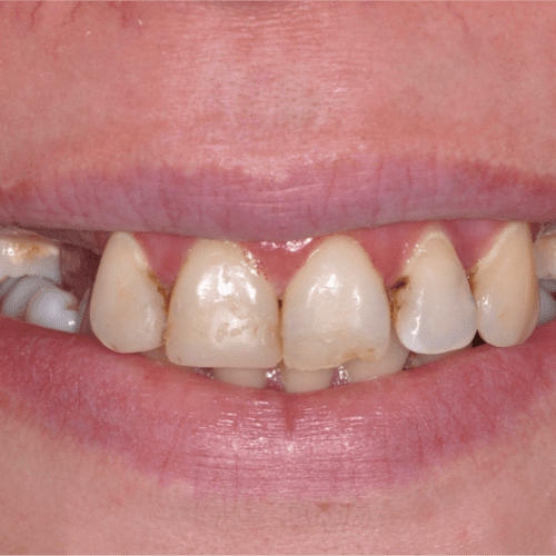 before treatment at Columbia Family Dentistry