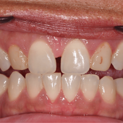 before treatment at Columbia Family Dentistry