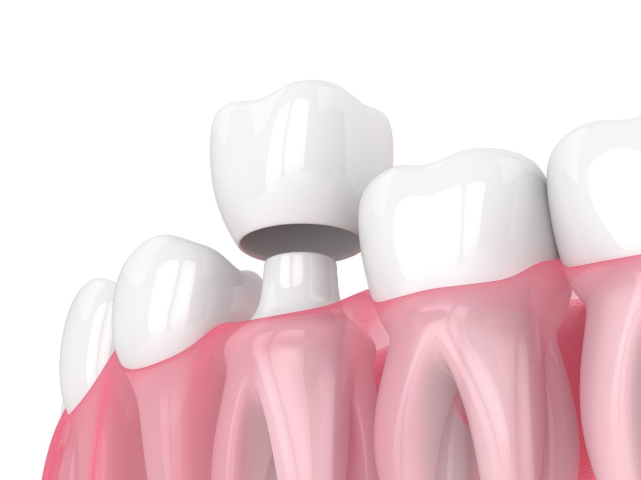 Dental crowns treatment