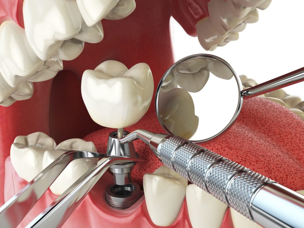 Dental Implant FAQs