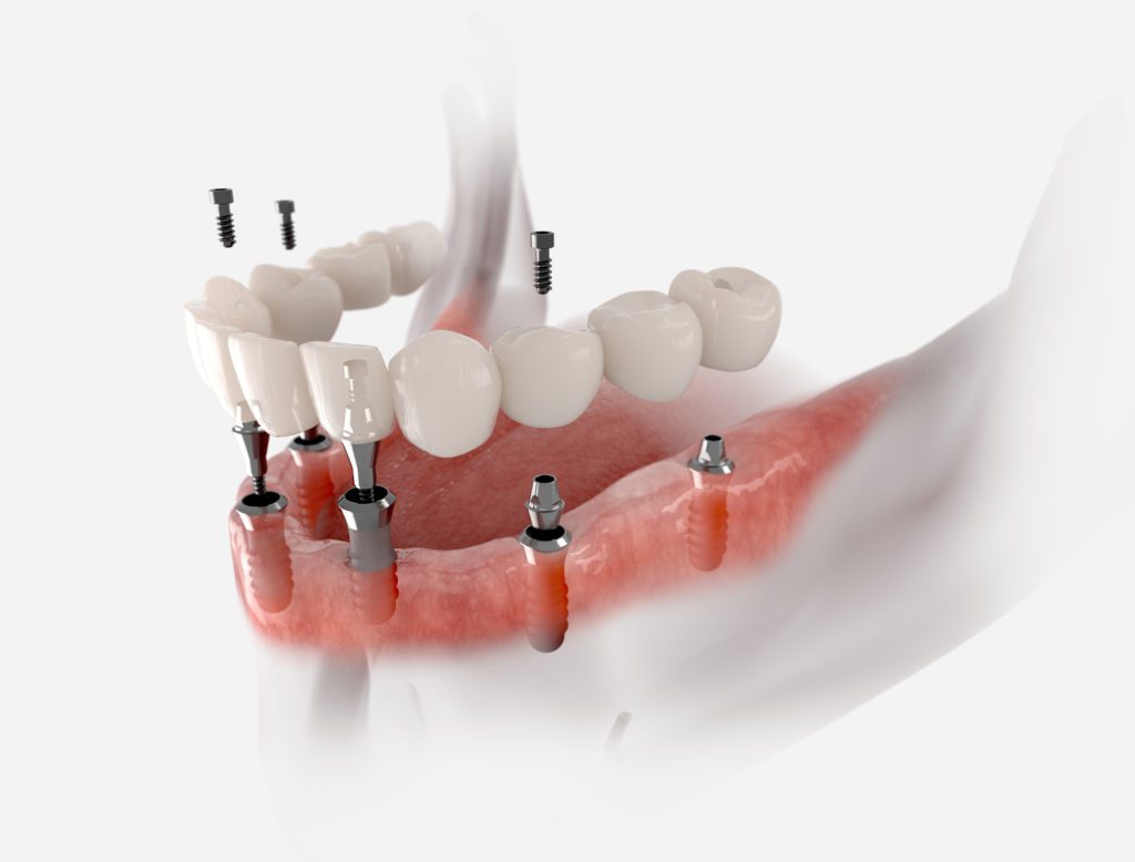 All-On-Four Dental Implant Concept