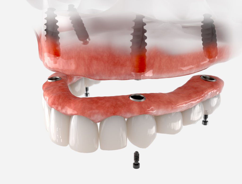All-on-four implant-supported dentures