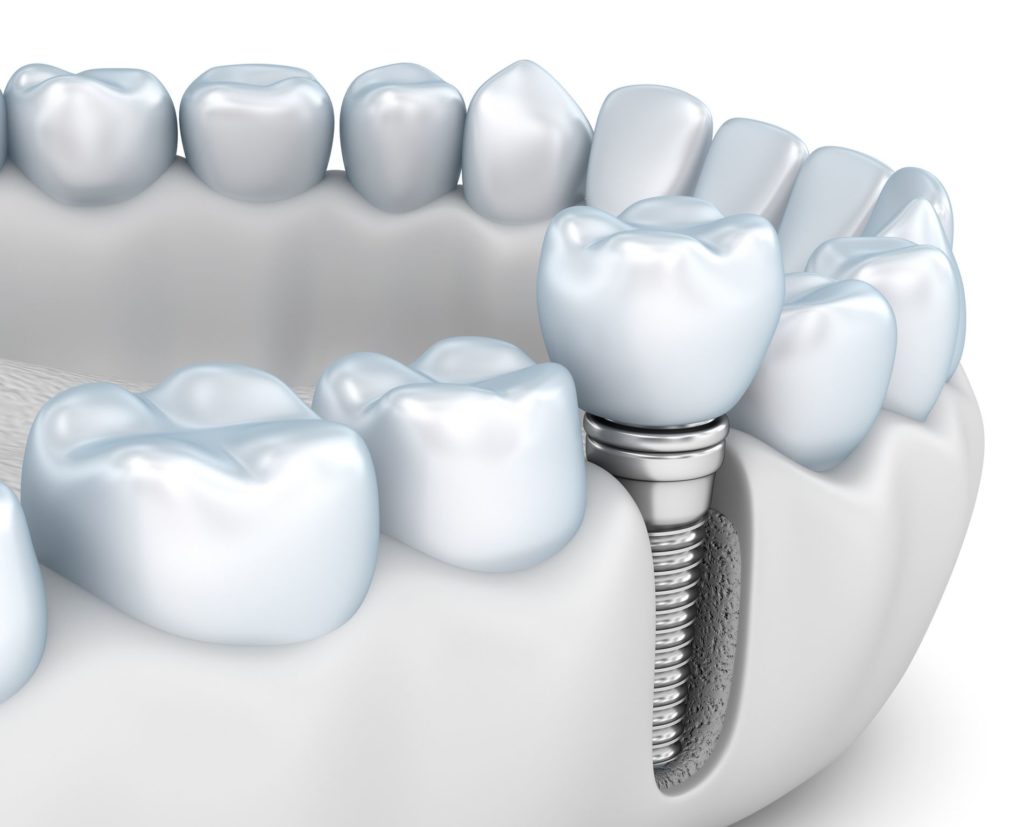 implant dentistry Columbia Maryland