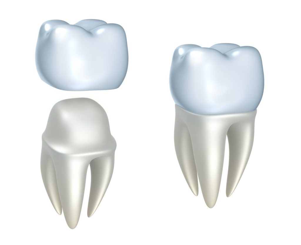 dental crown treatment Columbia Maryland
