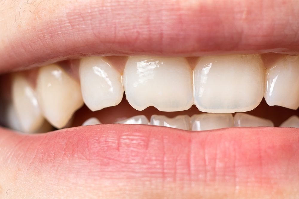 enamel damage in teeth