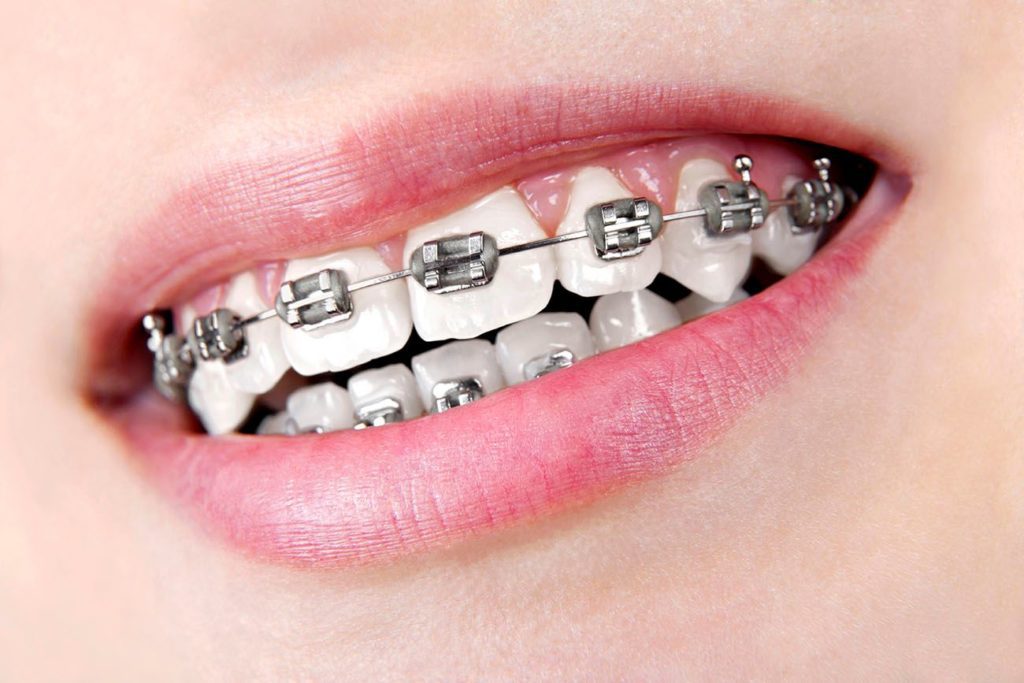 teeth straightening treatment with traditional metal braces