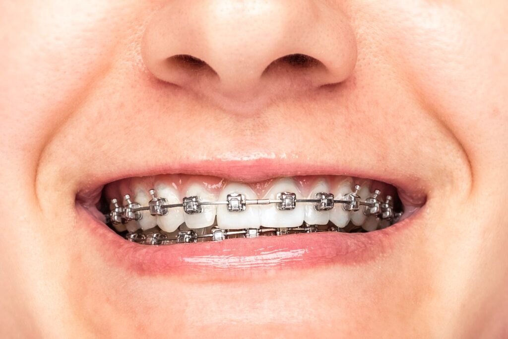 braces and other dental work options in Columbia Maryland
