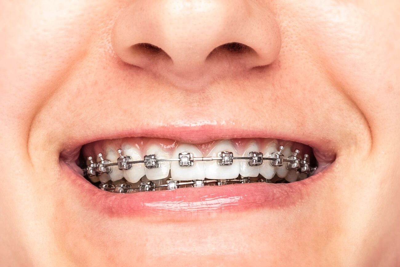 Dentistry When You Have Braces Dentist in Columbia, MD