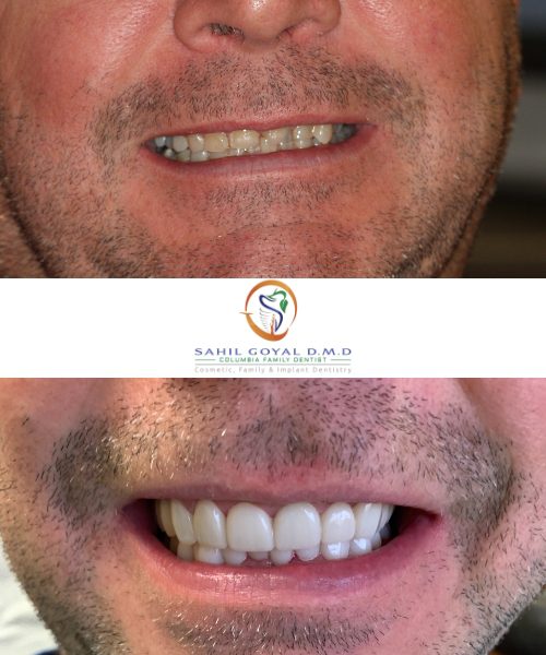 Before and after a smile makeover in Columbia, MD