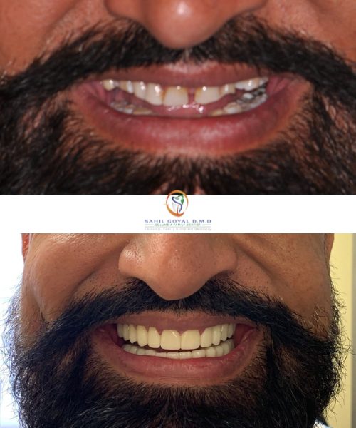 Patient before and after porcelain veneers