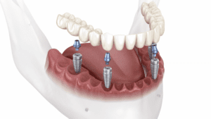 all on four implant denture columbia md