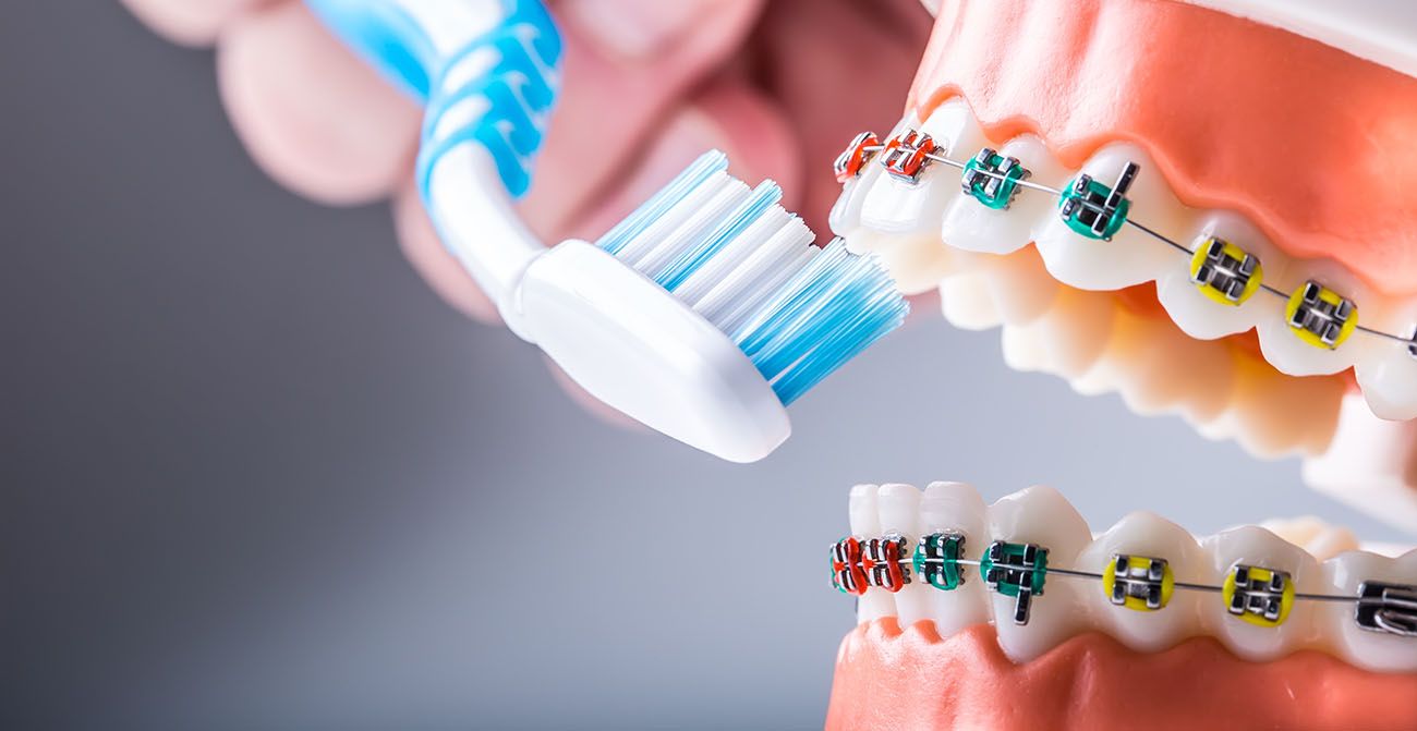 Oral Hygiene with Braces Cosmetic Dentist in Columbia, MD