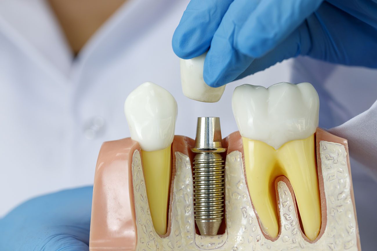Why Choose Dental Implants