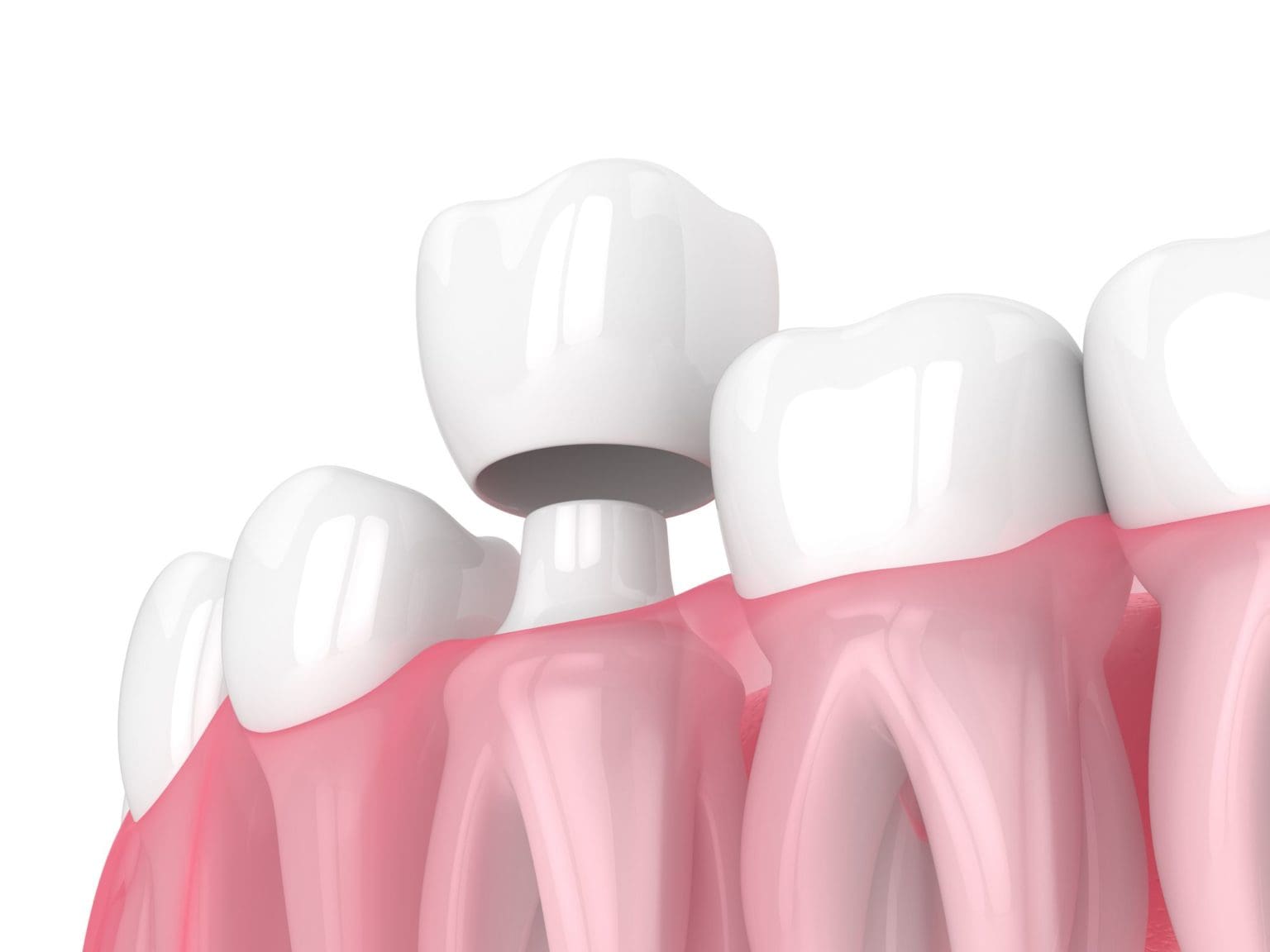 Dental crowns in Columbia, MD