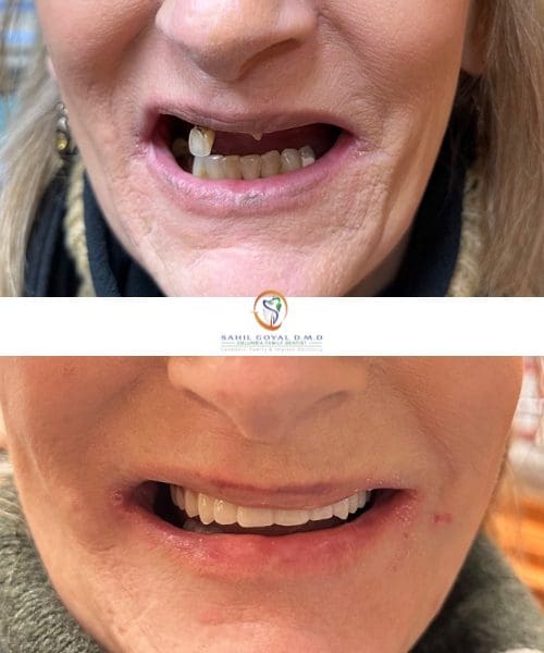 Patient before and after dental implants at Columbia Family Dentist