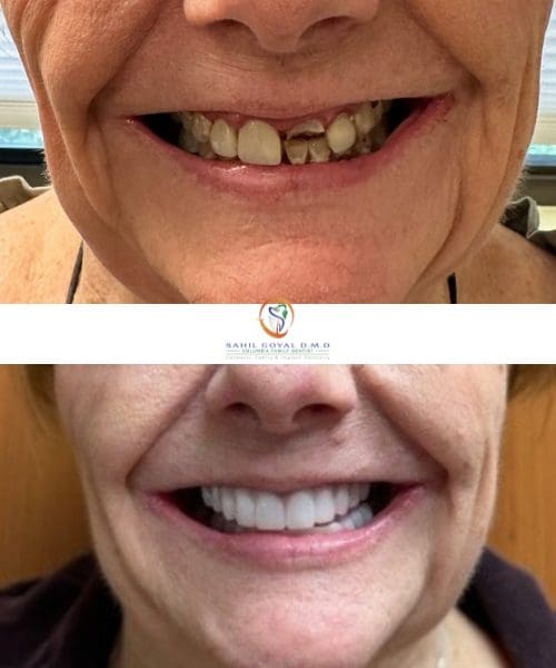 Patient before and after cosmetic dentistry at Columbia Family Dentist