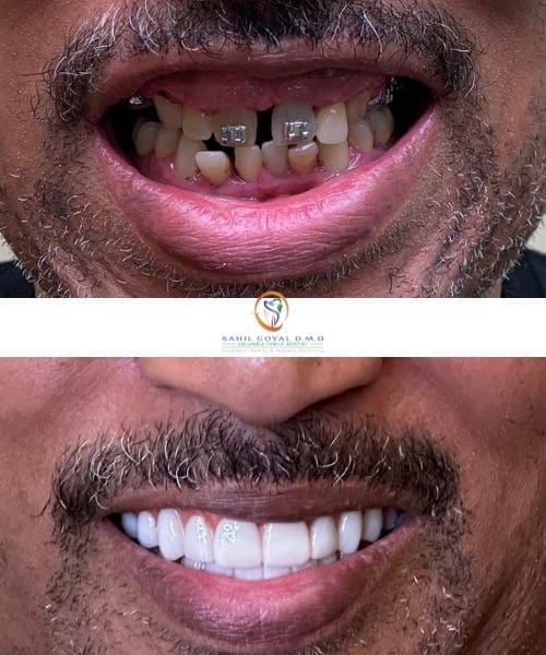 Dental patient before and after implants at Columbia Family Dentist
