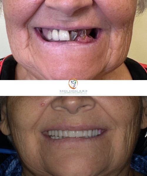 Dental patient before and after restorative dentistry at Columbia Family Dentist.
