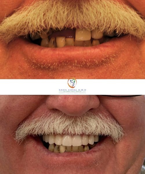 Patient before and after dentures in Columbia, MD