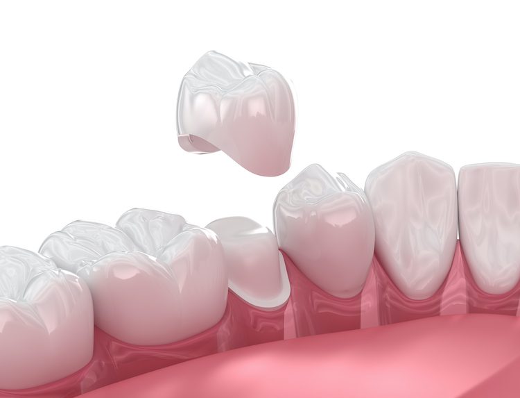 understanding when and why a dental crown is recommended can help you make informed decisions about your oral health.