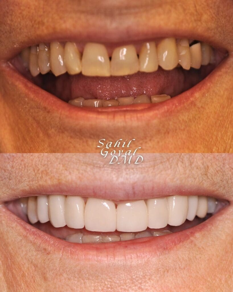Veneers Before and After at Veritas Dental Institute