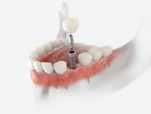 What Happens During a Dental Implant Procedure? in Columbia, MD