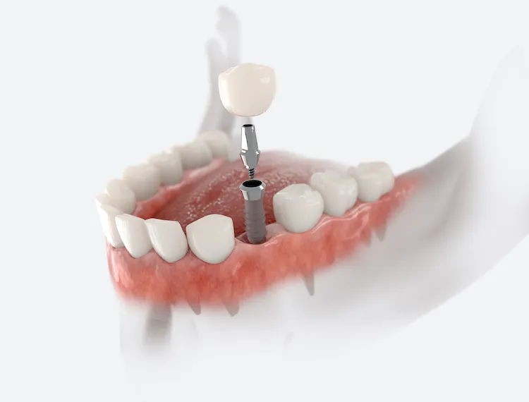 What Happens During a Dental Implant Procedure? in Columbia, MD